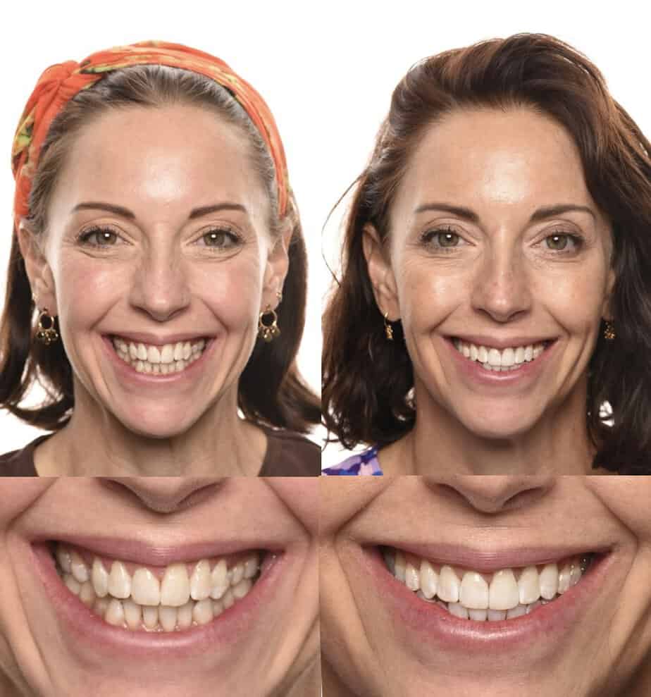 Smile alignment